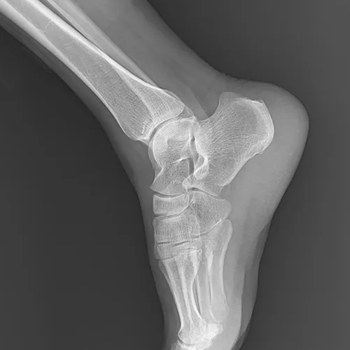 Limb radiograph