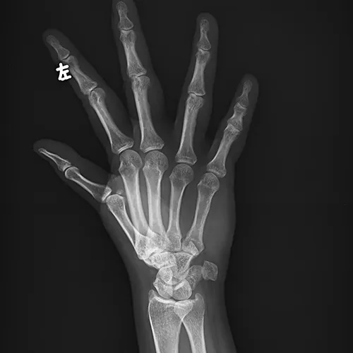 Limb radiograph