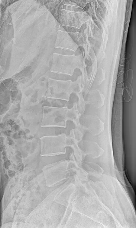  Lumbar radiograph