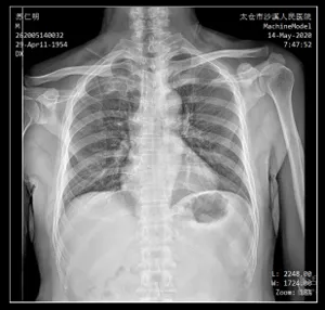 Ceiling-Mounted X-Ray Machine