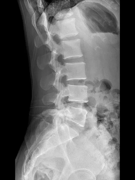 Lateral Spine radiograph