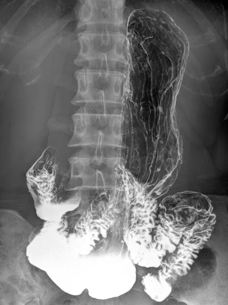 Stomach radiograph