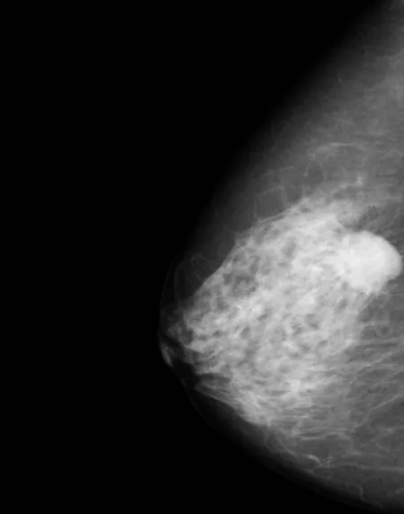 An image of a tumor